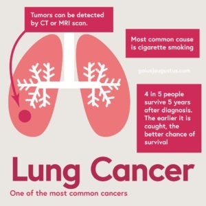Infographic about Lung Cancer, one of the most common cancers: Tumors can be detected by CT or MRI scan. Most common cause is cigarette smoking. 4 in 5 people survive 5 years after diagnosis. The earlier it is caught, the better chance of survival.